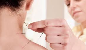Acupuncture Photo